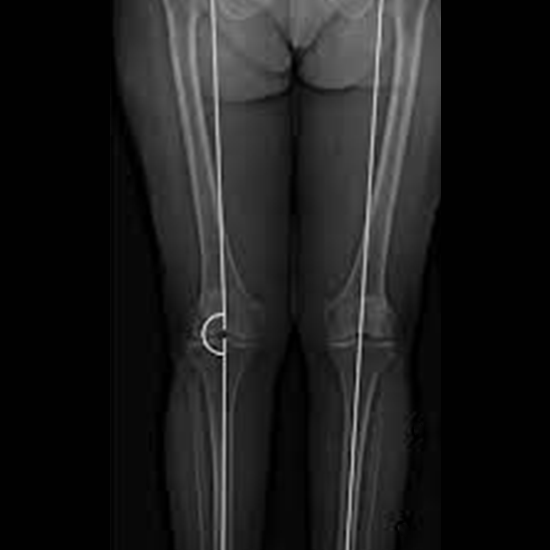 x-ray scanogram both lower limbs